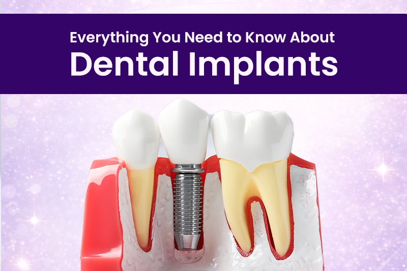 Dental Implants